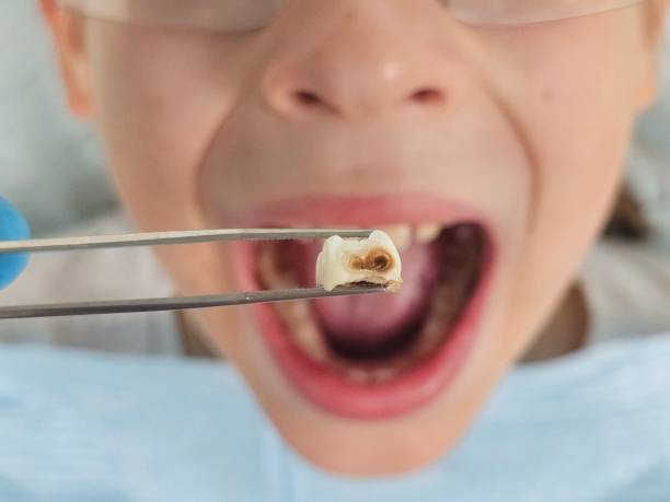 Best Emergency Treatment for Dental Infections or Abscesses in Beardstown, IL